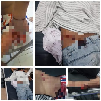 foto: Korban begal alami luka di beberapa bagian tubuhnya